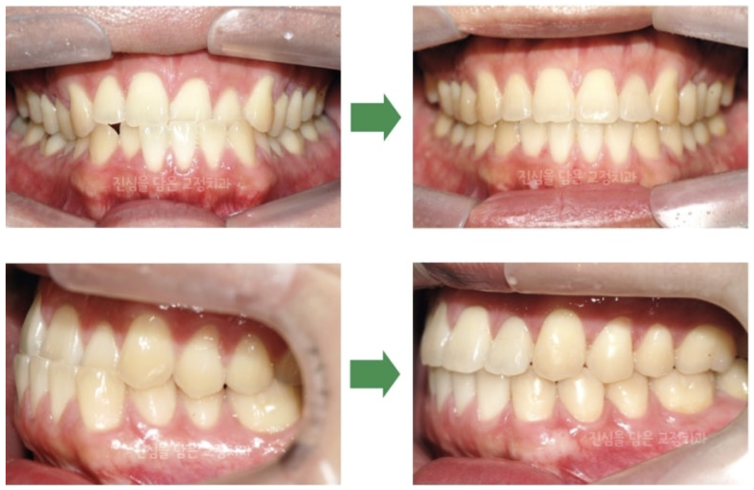 앞니가 거꾸로 물리고 치아가 삐뚤어진 30대 환자분의 교정 사례